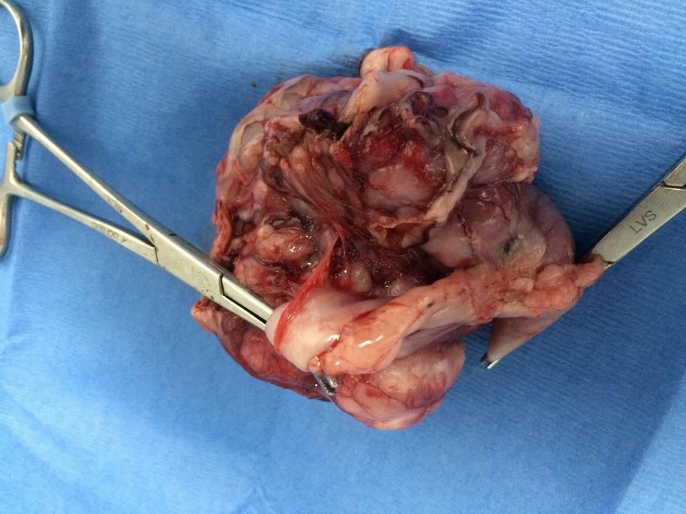 A mass of white cancerous intestinal tissue with surgical clamps on either end, laid on a blue towel background.